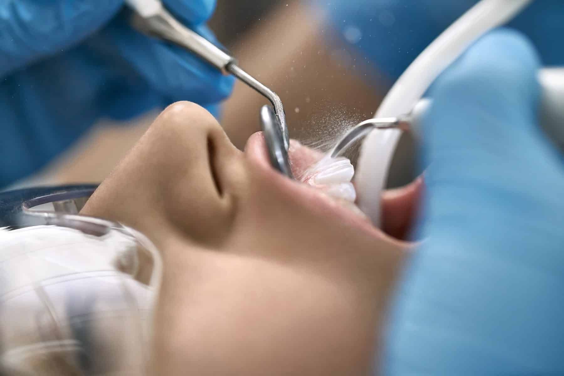 Teeth cleaning dentist in El Paso, TX